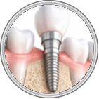 Implant Dentistry