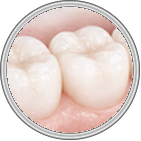 White Fillings