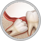 Wisdom Teeth